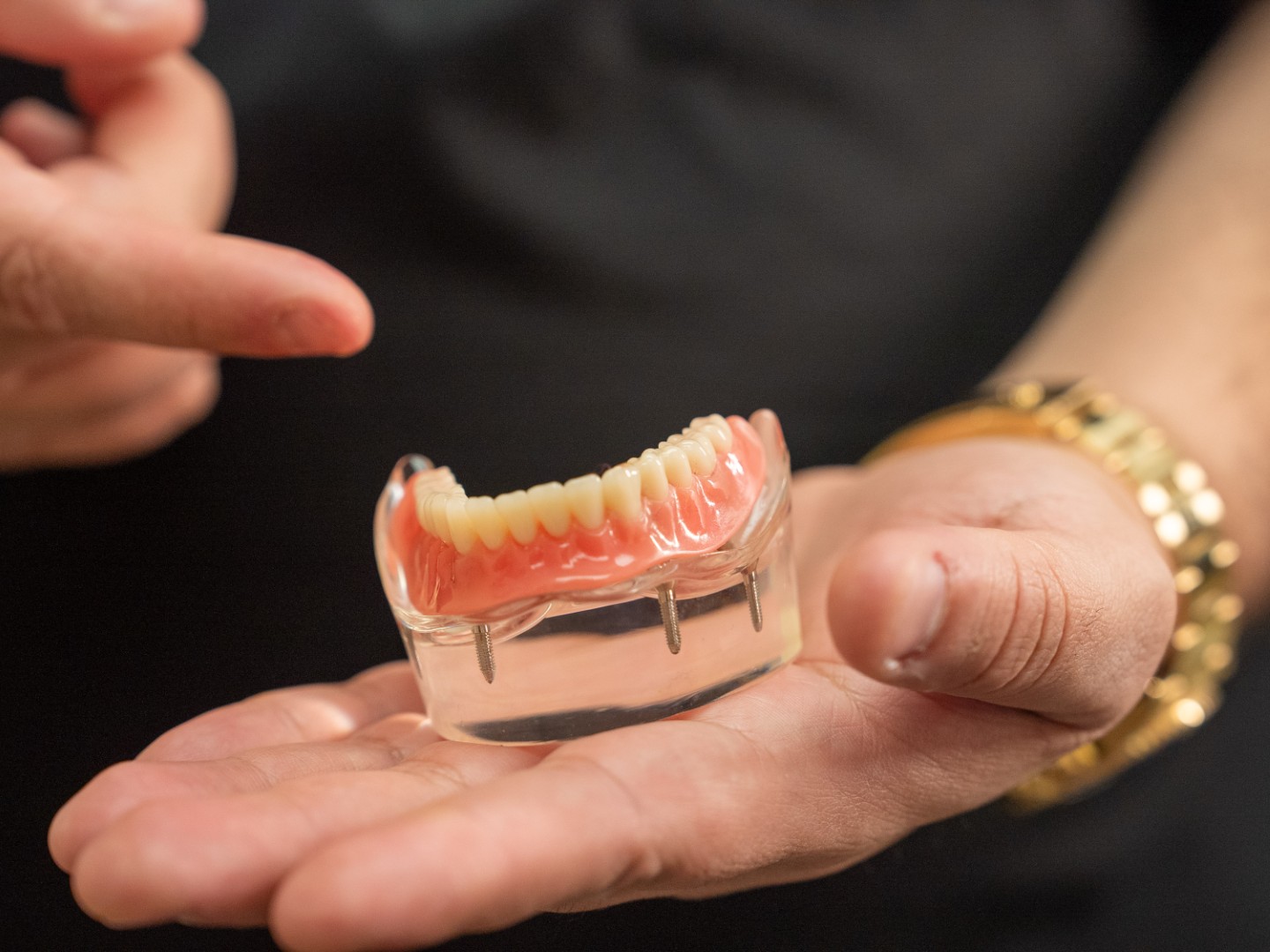 All On 4 Dental Implant Model